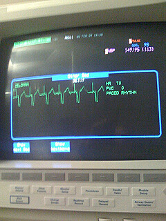 heart monitor